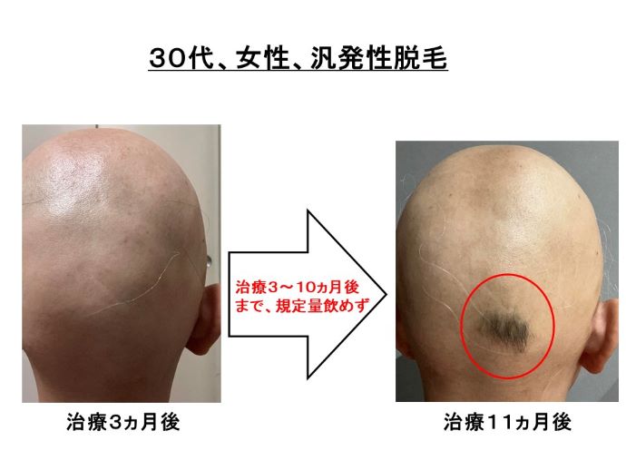 円形脱毛症　病院